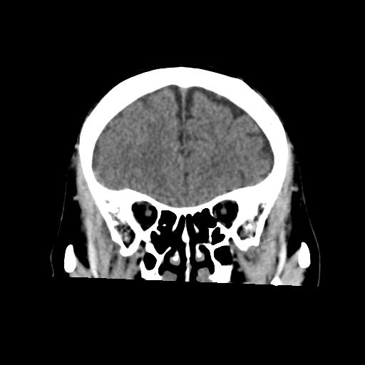 Atypical meningioma (WHO grade II) with osseous invasion (Radiopaedia 53654-59715 Coronal non-contrast 19).png
