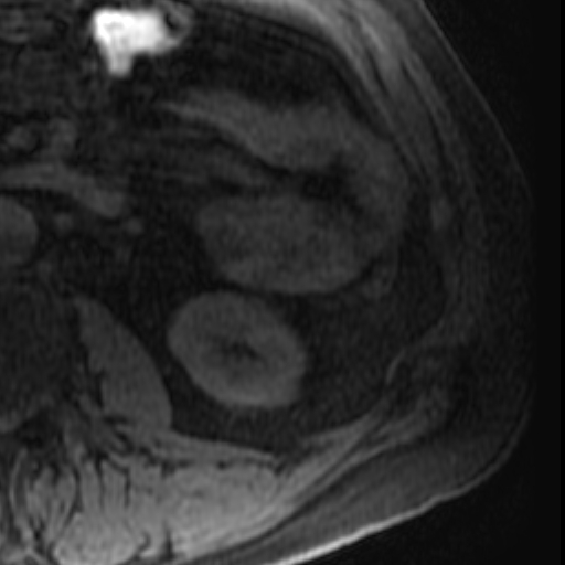 File:Atypical renal cyst on MRI (Radiopaedia 17349-17046 Axial T1 fat sat 26).jpg