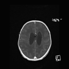File:Atypical teratoid rhabdoid tumor (prenatal US and neonatal MRI) (Radiopaedia 59091-66388 Axial T1 C+ 44).jpg