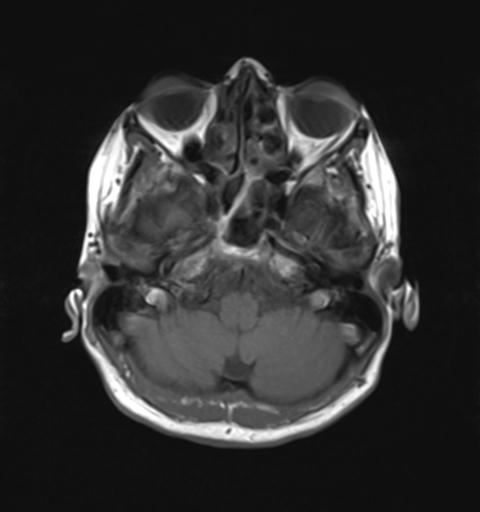 File:Autoimmune limbic encephalitis (Radiopaedia 30363-31005 Axial T1 7).jpg