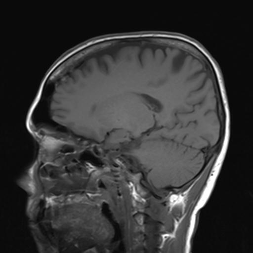 File:Autoimmune limbic encephalitis (Radiopaedia 30363-31005 Sagittal T1 10).jpg