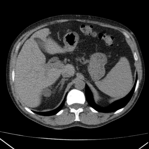File:Autosomal dominant polycystic kidney disease (Radiopaedia 36539-38101 Axial non-contrast 21).jpg