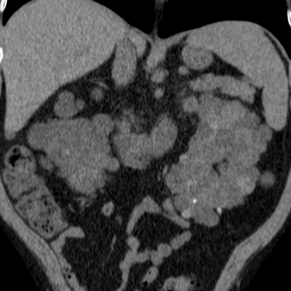 File:Autosomal dominant polycystic kidney disease (Radiopaedia 36539-38101 Coronal non-contrast 19).jpg