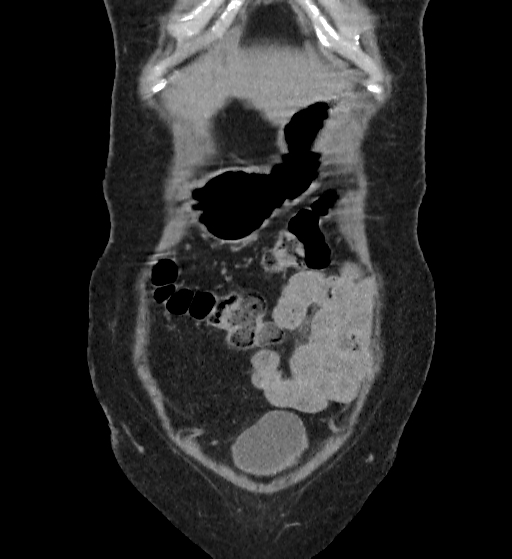 Autosomal dominant polycystic kidney disease (Radiopaedia 38189-40194 Coronal C+ delayed 2).jpg