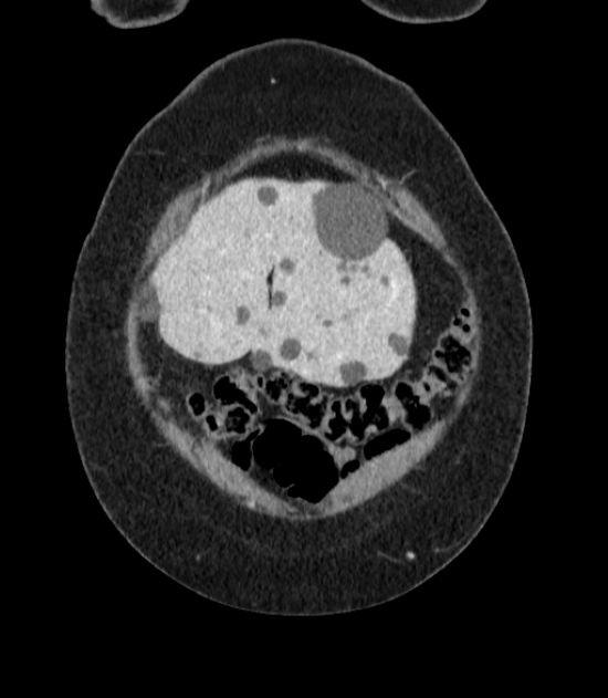 Autosomal dominant polycystic kidney disease (Radiopaedia 57124-64017 B 6).jpg