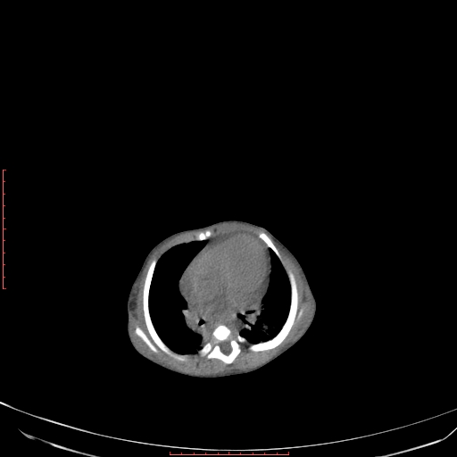 Autosomal recessive polycystic kidney disease associated with Caroli disease (Radiopaedia 61932-69984 Axial non-contrast 58).jpg