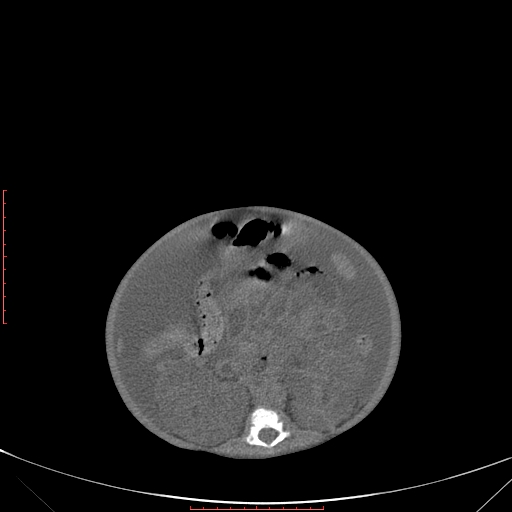 File:Autosomal recessive polycystic kidney disease associated with Caroli disease (Radiopaedia 61932-69984 B 217).jpg
