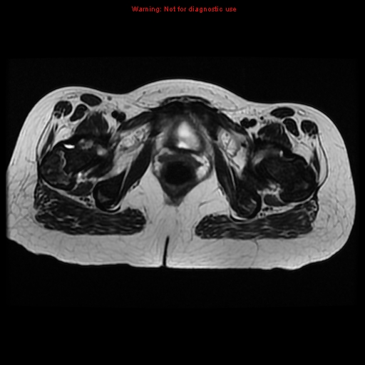 File:Avascular necrosis in sickle cell disease (Radiopaedia 17448-17151 Axial T2 12).jpg