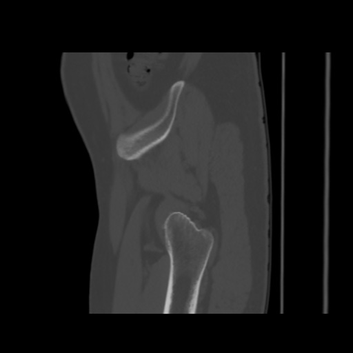 Avascular necrosis of the hip (Radiopaedia 61503-69467 B 8).jpg