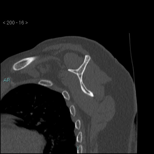 Avascular necrosis of the shoulder - Cruess stage I (Radiopaedia 77674-89887 Sagittal bone window 15).jpg