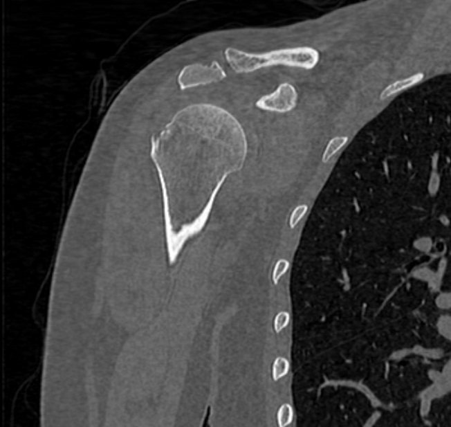 Avulsion fracture - greater tuberosity of humerus (Radiopaedia 71216-81514 Coronal bone window 22).jpg