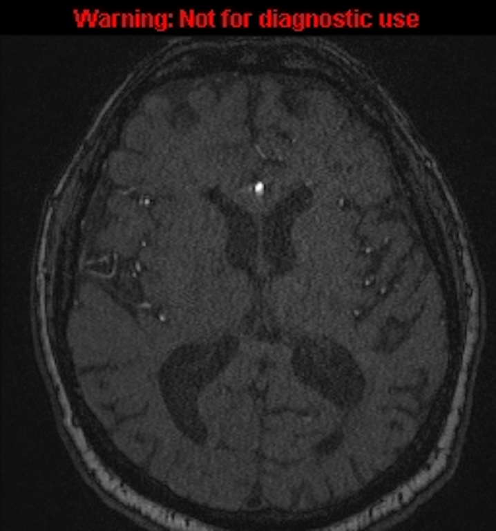 Azygos anterior cerebral artery (Radiopaedia 59325-66677 Axial MRA 96).jpg