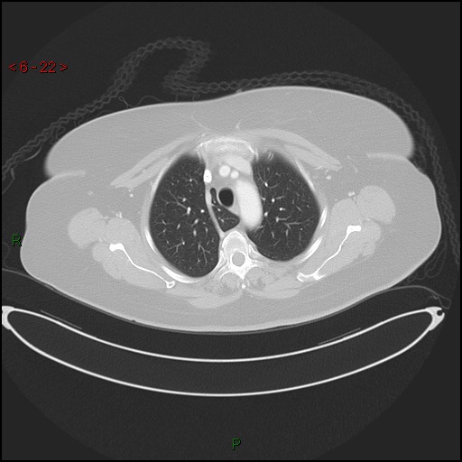 Azygos fissure and lobe (Radiopaedia 47620-52278 Axial lung window 22).jpg