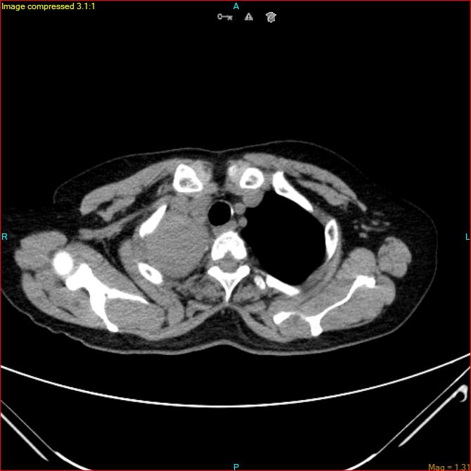 Azygos vein aneurysm (Radiopaedia 77824-90130 A 10).jpg