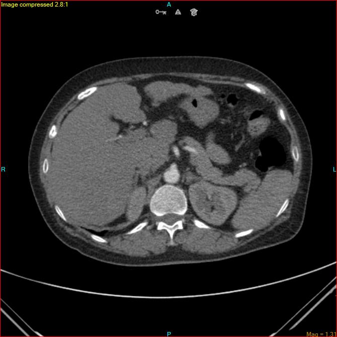 Azygos vein aneurysm (Radiopaedia 77824-90130 B 54).jpg