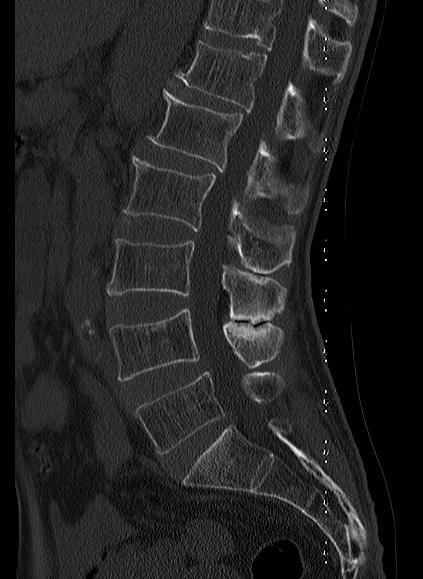 File:Baastrup syndrome (Radiopaedia 64891-73838 Sagittal bone window 10).jpg