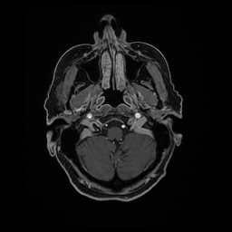 Balo concentric sclerosis (Radiopaedia 53875-59982 Axial LAVA C+ 42).jpg