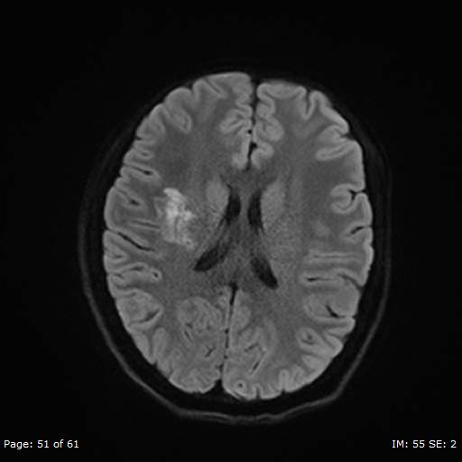 Balo concentric sclerosis (Radiopaedia 61637-69636 Axial DWI 51).jpg