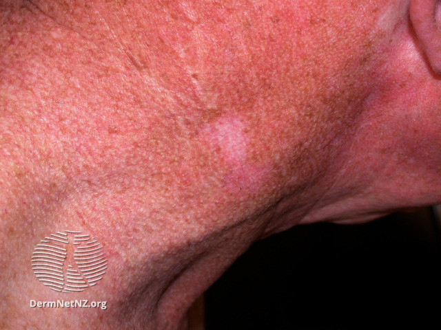 File:Basal cell carcinoma affecting the face (DermNet NZ lesions-bcc-face-0874).jpg