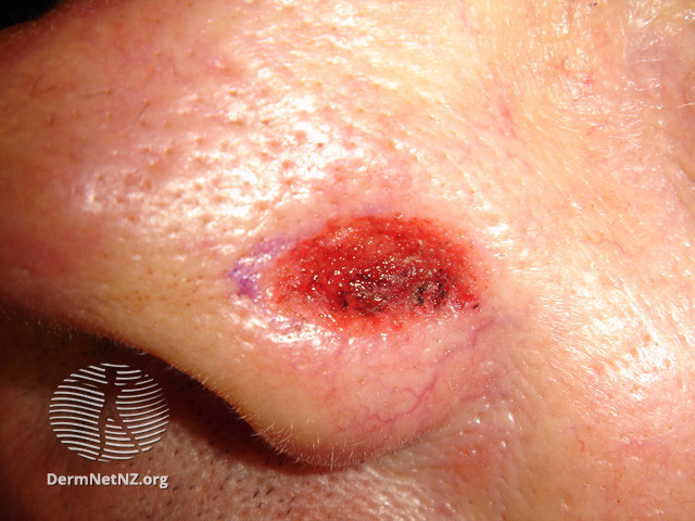 File:Basal cell carcinoma affecting the nose (DermNet NZ lesions-bcc-nose-0827).jpg