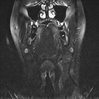File:Base of tongue squamous cell carcinoma (Radiopaedia 31174-31884 Coronal T2 fat sat 17).jpg