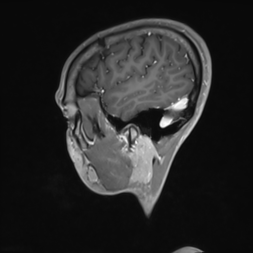 Basilar artery perforator aneurysm (Radiopaedia 82455-97733 G 27).jpg