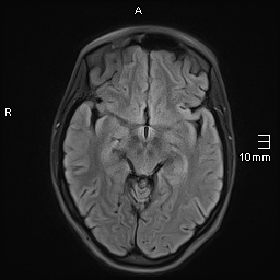 File:Basilar artery perforator aneurysm (Radiopaedia 82455-99523 Axial FLAIR 10).jpg