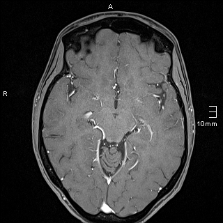 Basilar artery perforator aneurysm (Radiopaedia 82455-99523 G 64).jpg