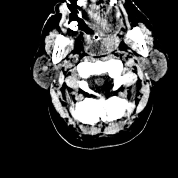 Basilar artery thrombosis (Radiopaedia 53351-59352 Axial non-contrast 11).jpg