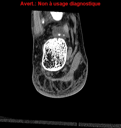 Baxter neuropathy (Radiopaedia 25988-26125 Coronal non-contrast 35).jpg