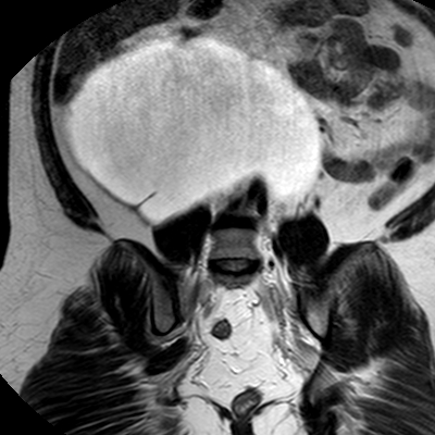 File:Benign seromucinous cystadenoma of the ovary (Radiopaedia 71065-81300 F 20).jpg