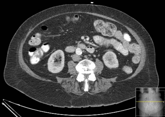 File:Bicameral celiacomesenteric aneurysm (Radiopaedia 55766-62327 A 34).jpg