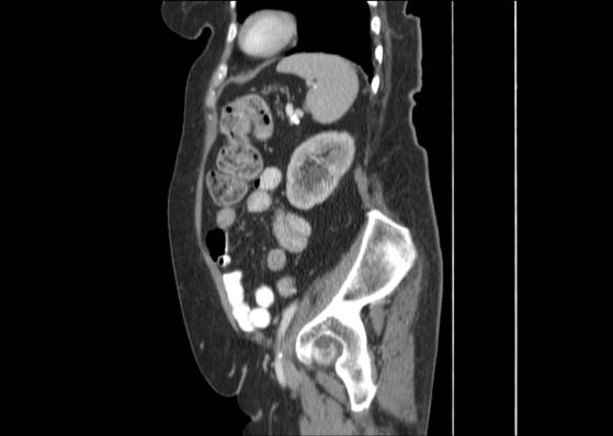 Bicameral celiacomesenteric aneurysm (Radiopaedia 55766-62327 B 42).jpg