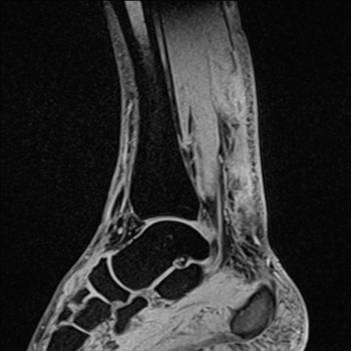 Bilateral Achilles tendon complete tear (Radiopaedia 81344-95051 Sagittal WE - Right 66).jpg