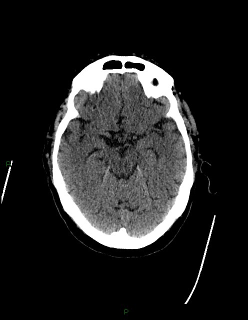 Bilateral acute middle cerebral artery territory infarcts (Radiopaedia 77319-89401 Axial non-contrast 33).jpg