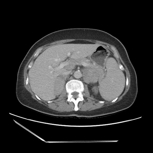 Bilateral adrenal granulocytic sarcomas (chloromas) (Radiopaedia 78375-91007 A 38).jpg
