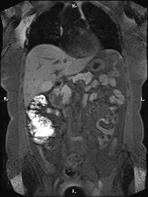 File:Bilateral adrenal myelolipoma (Radiopaedia 63058-71537 Coronal T1 fat sat 64).jpg