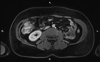 Bilateral adrenal myelolipoma (Radiopaedia 63058-71537 G 61).jpg