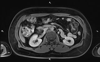 File:Bilateral adrenal myelolipoma (Radiopaedia 63058-71537 H 50).jpg