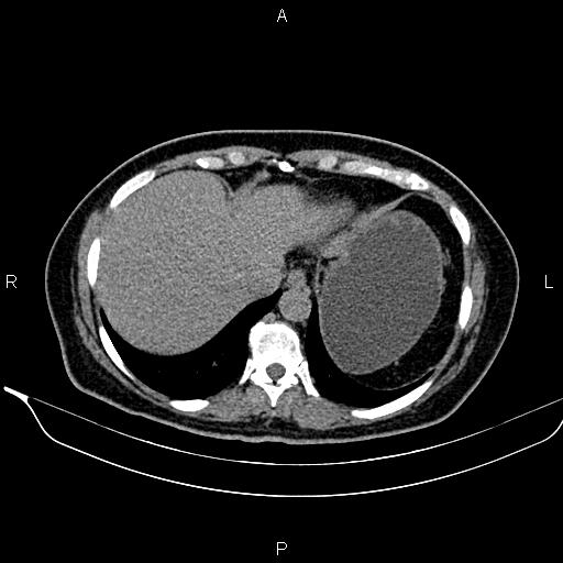 Bilateral benign adrenal adenomas (Radiopaedia 86912-103124 Axial non-contrast 20).jpg