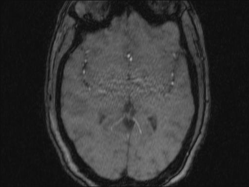 Bilateral carotid body tumors and right glomus jugulare tumor (Radiopaedia 20024-20060 Axial MRA 347).jpg