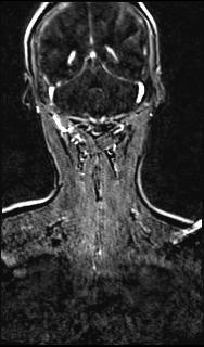 Bilateral carotid body tumors and right glomus jugulare tumor (Radiopaedia 20024-20060 MRA 133).jpg