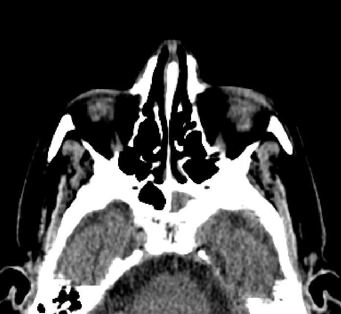 Bilateral ectopia lentis (Radiopaedia 89889-107013 Axial non-contrast 64).jpg