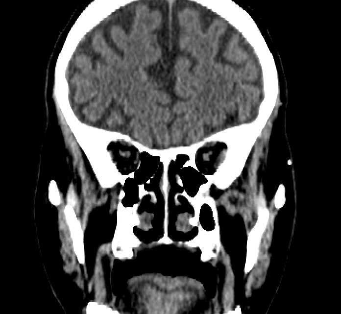 Bilateral ectopia lentis (Radiopaedia 89889-107013 Coronal non-contrast 87).jpg