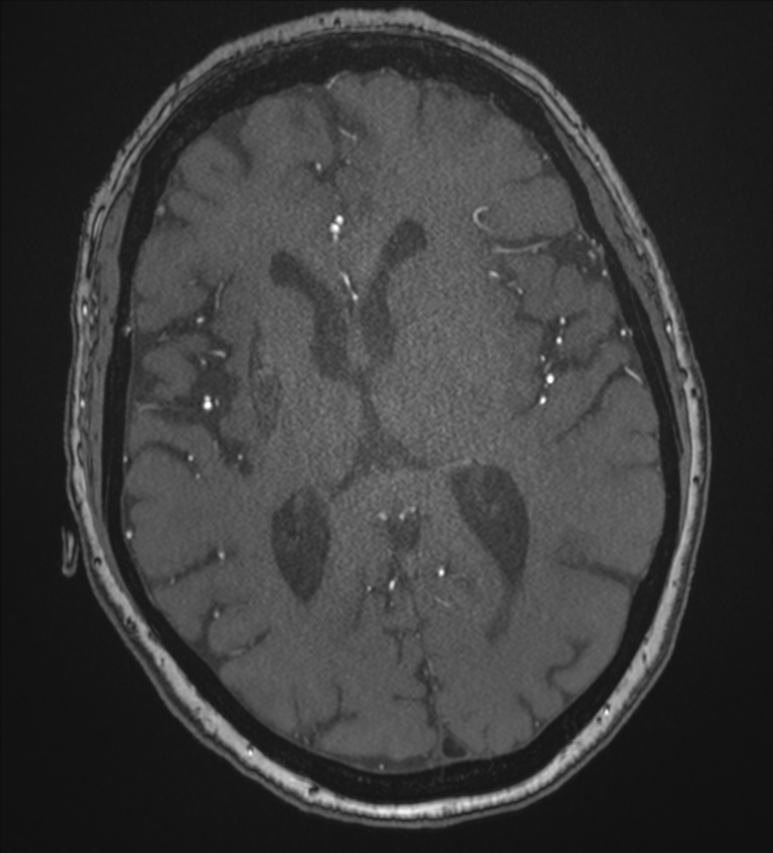 Bilateral fetal posterior communicating arteries (Radiopaedia 41286-44102 Axial MRA 119).png