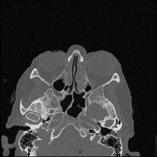 Bilateral frontal mucoceles (Radiopaedia 82352-96454 Axial bone window 158).jpg