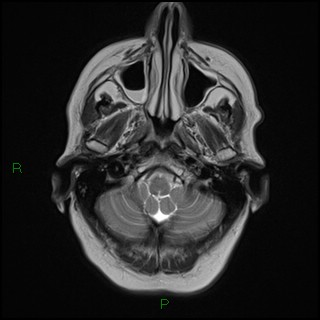File:Bilateral frontal mucoceles (Radiopaedia 82352-96455 Axial T2 2).jpg