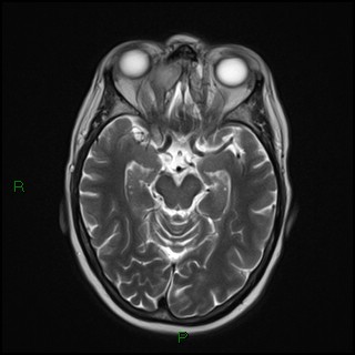 File:Bilateral frontal mucoceles (Radiopaedia 82352-96455 Axial T2 8).jpg