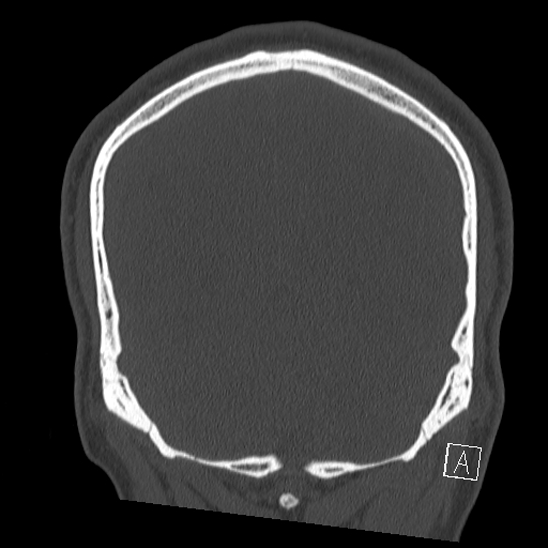 Bilateral occipital condyle fracture (type 2) (Radiopaedia 87675-104089 Coronal bone window 113).jpg