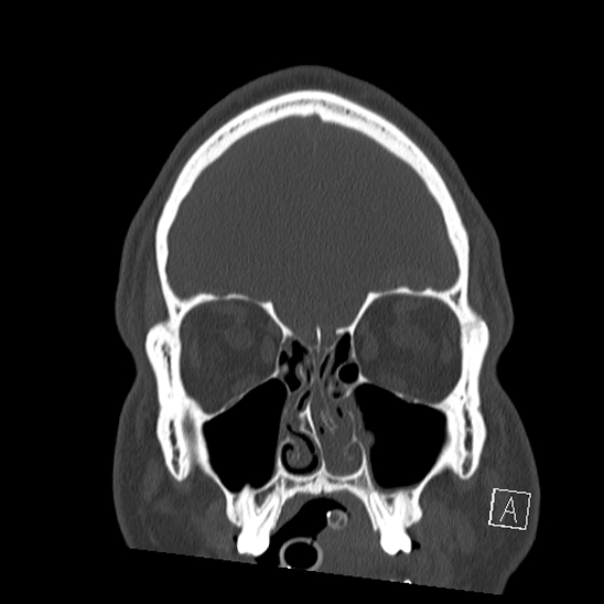 Bilateral occipital condyle fracture (type 2) (Radiopaedia 87675-104089 Coronal bone window 13).jpg